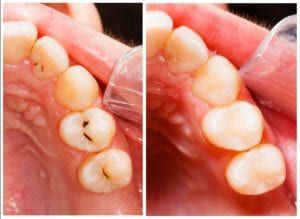 Composite filling on a tooth